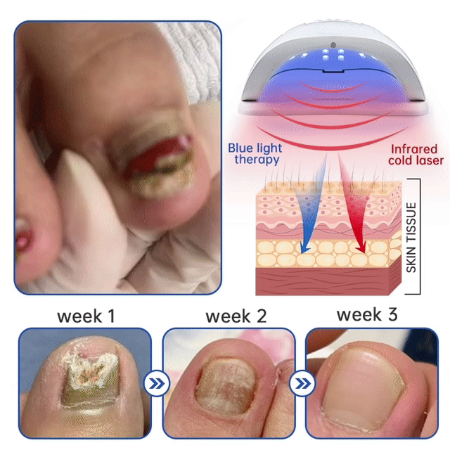 ODEIUN Fungus Laser Therapy Device