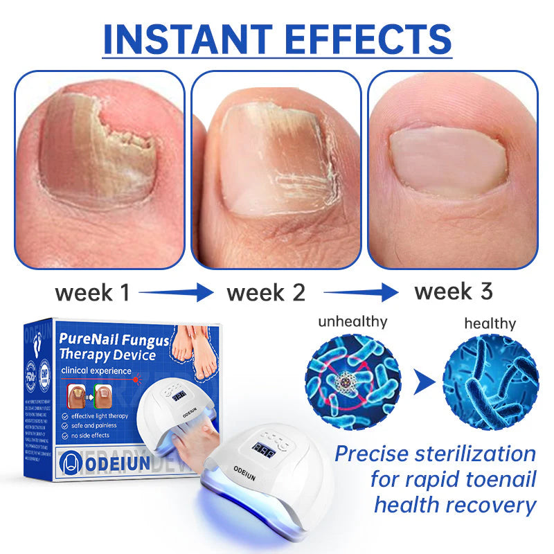 ODEIUN Fungus Laser Therapy Device