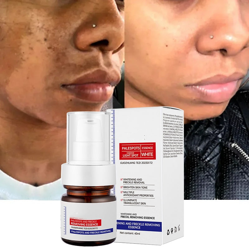 🔥FLASH SALE 50%：5-second brightening rescue: Dark spots disappear, blemishes fade, and skin becomes radiant! Vitamin C Whitening Freckles ESSENCE(3 HOURS LEFT!)